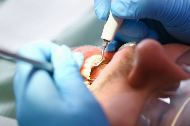 Best Broken or Chipped Tooth Repair in Lebanon, TN