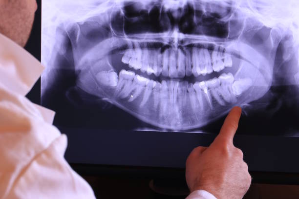 Best Knocked-Out Tooth (Avulsed Tooth) Treatment in Lebanon, TN